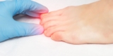 How to Treat and Prevent Nail Fungus Naturally